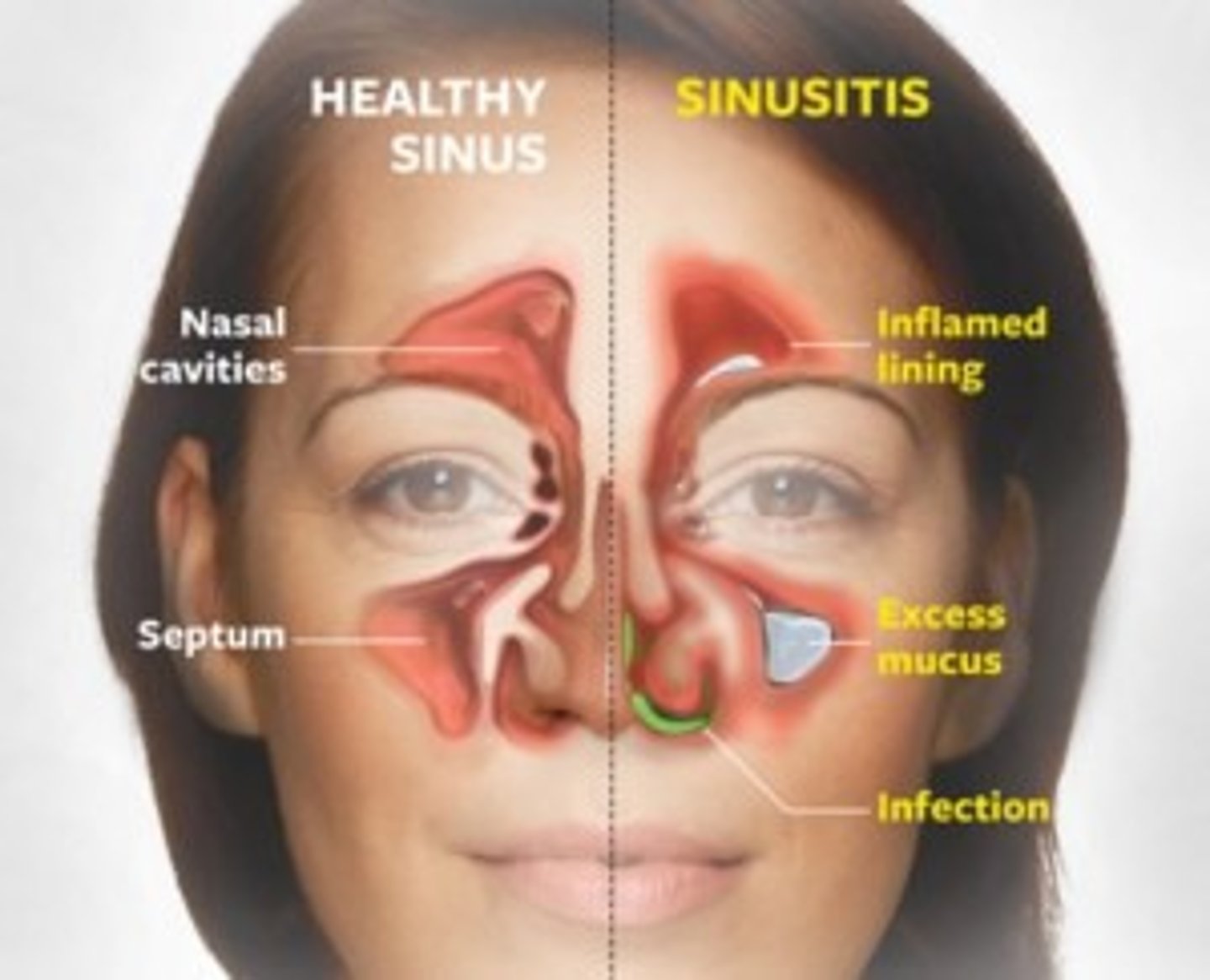 <p>symptomatic inflammation of the mucousa, nasal cavity, and paranasal sinuses lasing LESS THAN than 4 weeks</p>