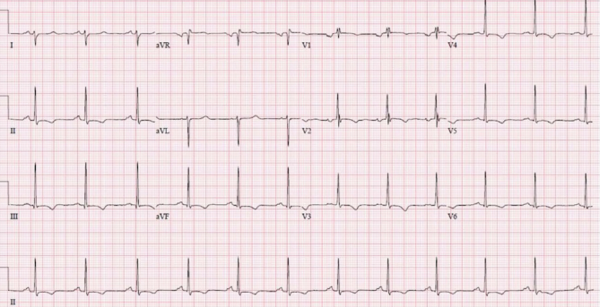 <p>Interpret this ECG</p>