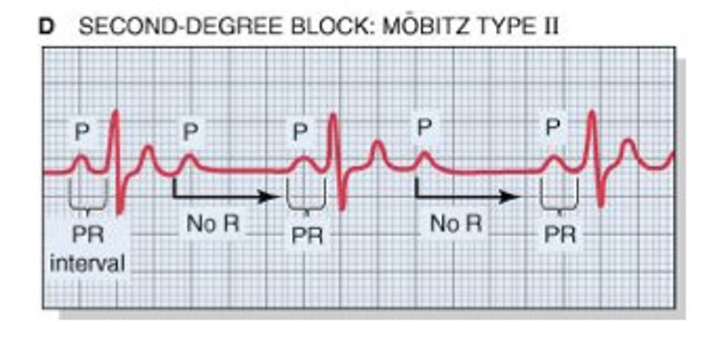 <p>blocked atrial contractions (extra P waves with no QRS)</p><p>PR interval = within normal limits/consistent until a P wave is not conducted (stranded P waves are seen); no progressive lengthening of PR interval</p><p>ventricular rate &lt; atrial rate</p><p>NOT SEEN IN NORMAL HEARTS</p>