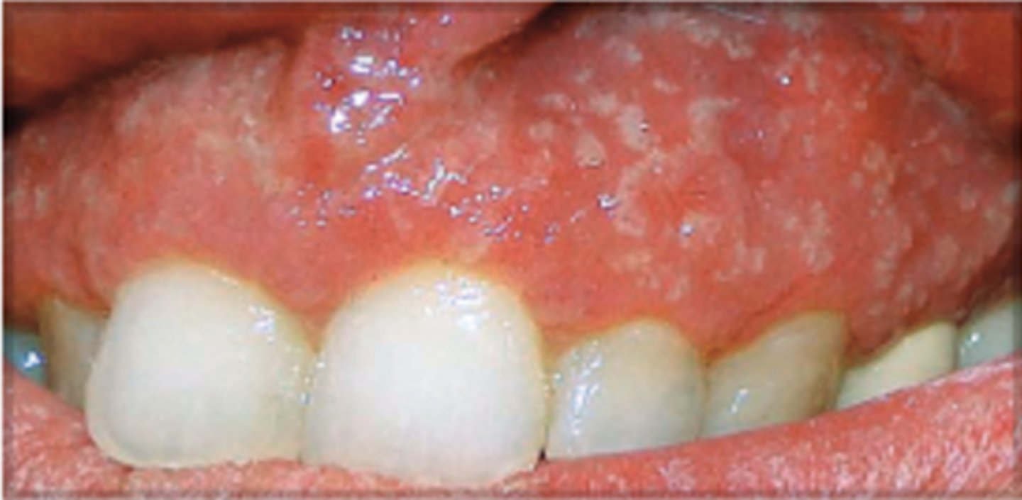 <p>A 20 year-old patient presents with abdominal pain, bloody diarrhea and anemia. Oral exam reveals erythema and pustules on the gingival mucosa as shown in the image. She also has joint pains. A relative had the same disease and had a colectomy which revealed colon cancer. Which of the following conditions does this patient most likely have?</p><p>A. Crohn's disease</p><p>B. Ulcerative colitis</p><p>C. Celiac disease</p><p>D. Gardner's syndrome</p><p>E. Mucocutaneous telangiectasia</p>