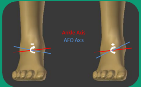 <p>Unequal pressure distribution on the foot, causing callus formation </p><p>Increased wear of joints </p><p>Lateral instability from reduced shoe area contacting floor </p>