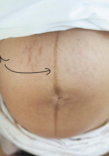 <p>Brown line through belly to pubic symphysis </p>
