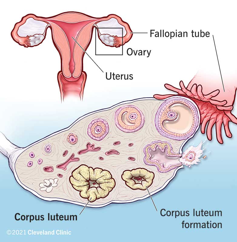 <p>after ovulation → remaining follicle collapses → corpus rubrum → corpus luteum (vascularised) → will continue to produce oestrogens</p>
<p>vascularisation of the complete corpus luteum enables the luteal granulosa cells to produce progesterone + inhibin A → decrease in FSH and LH</p>
<p>eventually, the decrease in LH will cause the stimulation of the corpus luteum to decrease → decrease in progesterone, oestradiol and inhibin A → corpus luteum ‘dissolves’ → endometrium lining the uterus will also become less vascularized and will therefore shed from its basal lamina resulting in ==<strong>menstrual blood flow</strong>==</p>
<p>→ feedback of oestradiol, progesterone and inhibin A on the hypothalamus and pituitary → increase in FSH again to recruit follicles for the next menstrual cycle</p>