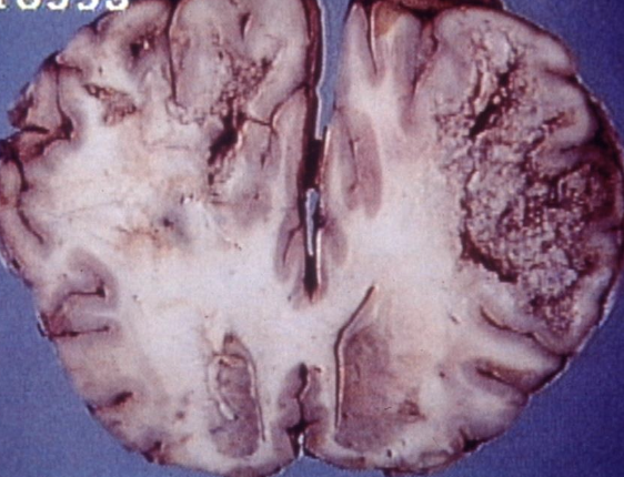 <ul><li><p>necrosis of subcortical white matter, one or both hemispheres, asymmetrical</p></li><li><p>hepatic necrosis, fibrosis, biliary hyperplasia </p></li></ul><p></p>