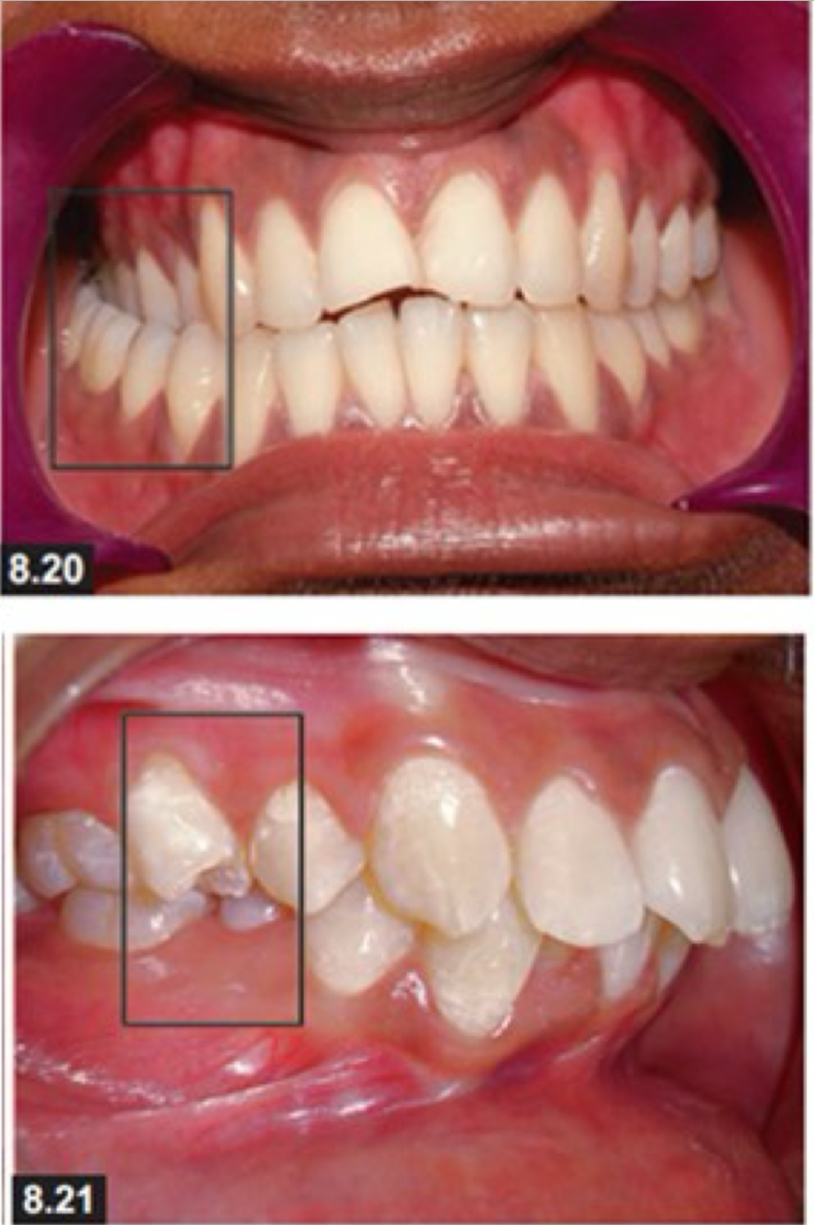 <p>Crossbite- teeth are misaligned but they contact</p><p>Scissor bite- teeth don’t contact </p>