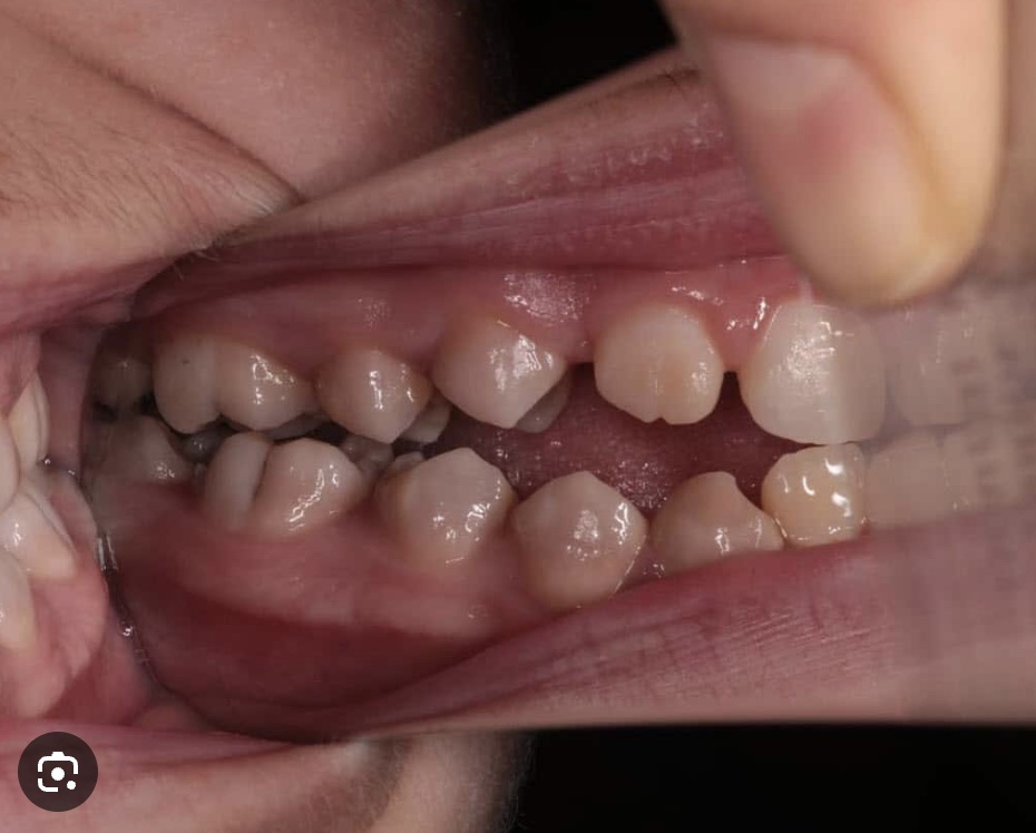 <p>what is the warranty for radiographic imaging for a NEW PATIENT child with primary dentition?</p>