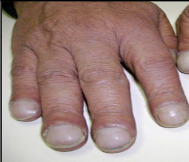 <p>abnormal downward curve and bluish coloration of the fingernails accompanied by stunted growth of the fingers. Associated with lack of oxygen in cystic fibrosis.</p>
