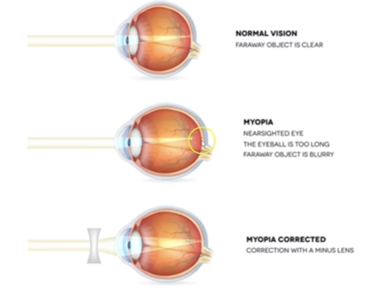 <p>What happens when eyeball when myopia occurs?</p>