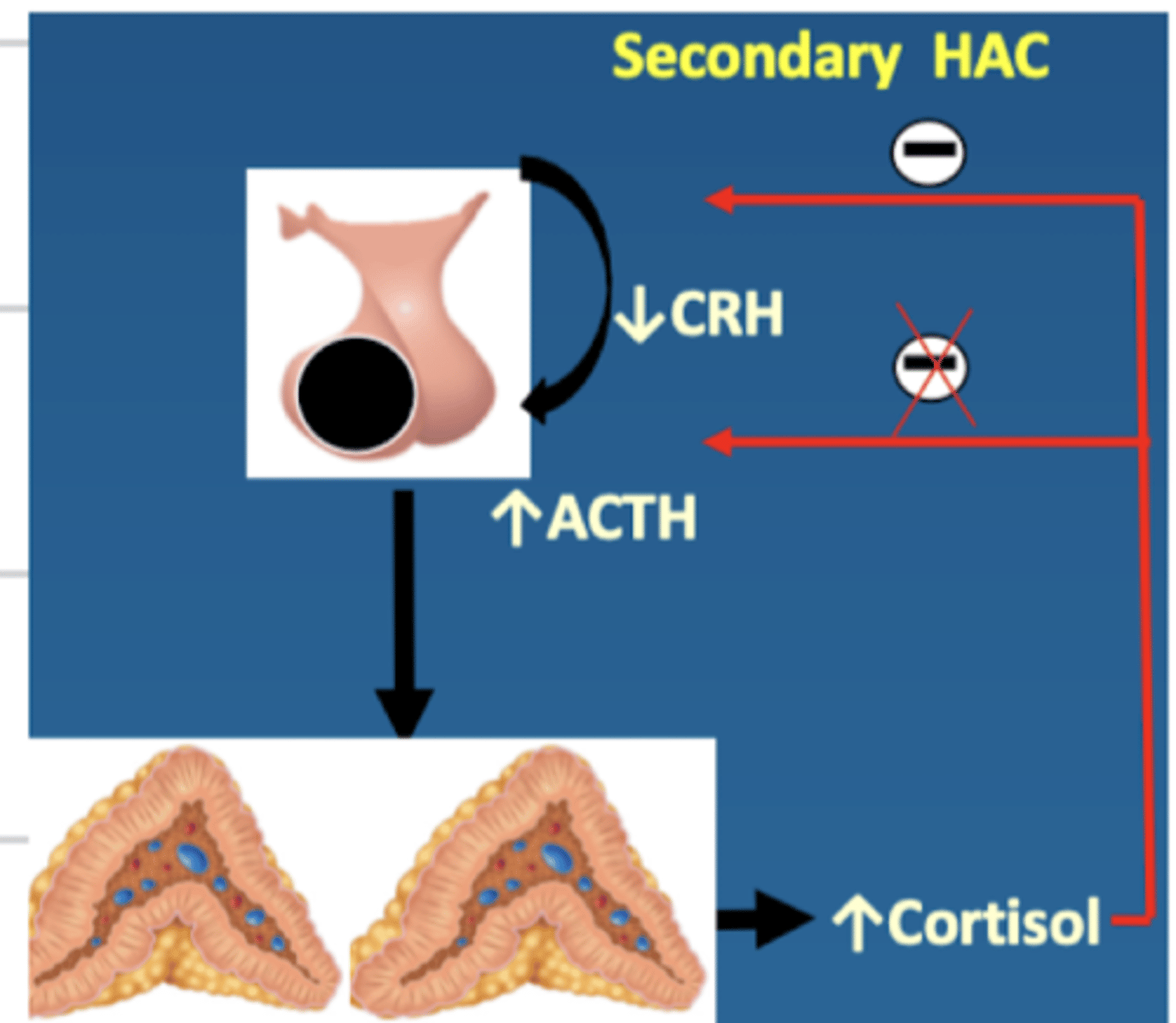 <p>↑ cortisol</p><p>↓ CRH</p><p>↑ ACTH</p>