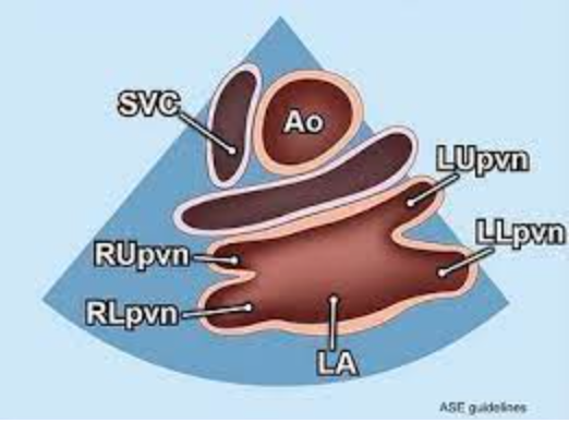 <p>The image below visualizing the LA and all four pulmonary veins represents which one of the following echocardiographic views?</p>