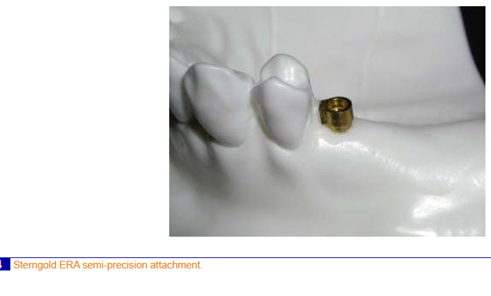<ul><li><p>laboratory fabricated rigid metallic extension (patrix) of a fixed or removable dental prosthesis that fits into a slot-type keyway (matrix) in a cast restoration</p></li><li><p>Allows some movement between the compnents</p></li></ul><p></p>