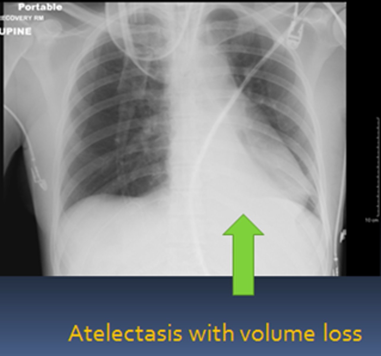 <p>CXR</p>