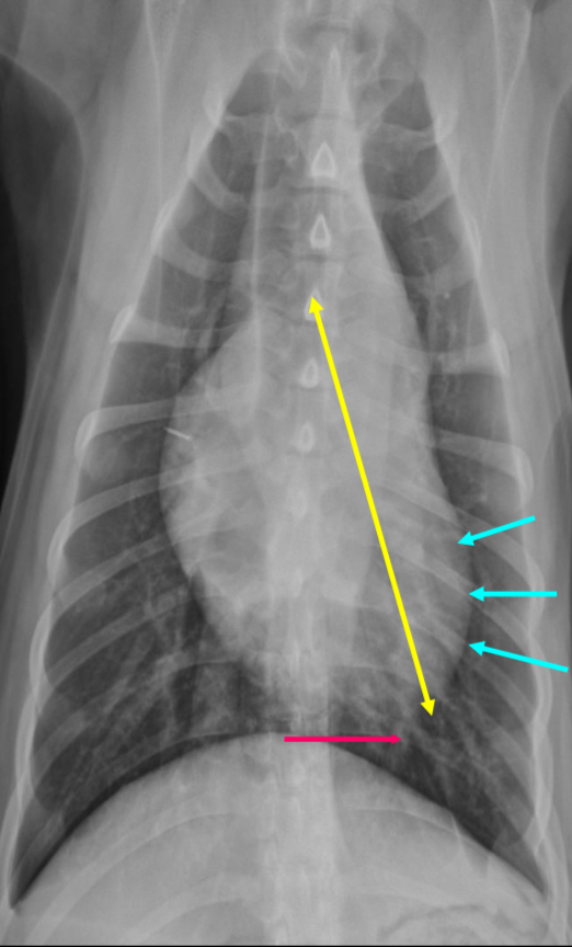 <p>-elongation of cardiac silhouette</p><p>-deviation of apex to the left</p><p>-bulge at 3-5 o’clock</p>