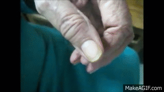 <p>A progressive neurological disorder that affects movement. It is characterized by an asymmetrical <strong>‘pill-rolling’ resting tremor</strong> (a rhythmic movement resembling rolling a pill between fingers), <strong>bradykinesia</strong>, <strong>rigidity</strong> and <strong>gait instability</strong></p>