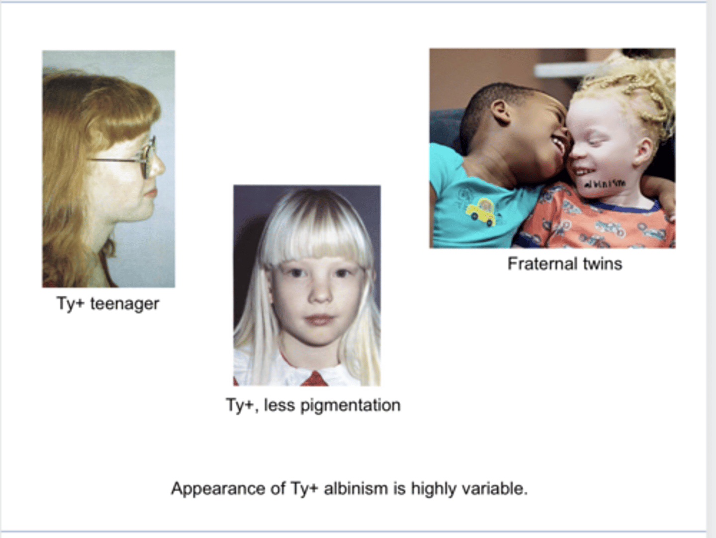 <p>Tyrosinase (+) Albinism Appearance -- Variable (Pic)</p>