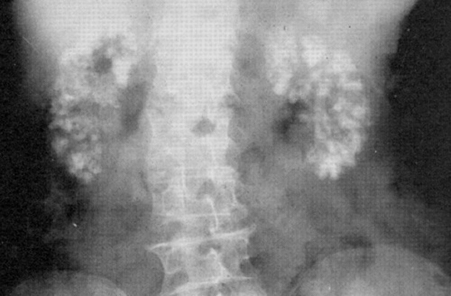 <p>- What refers to calcium deposits in the renal parenchyma that is caused by disorders that affect the calcium levels in the body?</p><p>- What are the disorders that cause this pathology?</p>