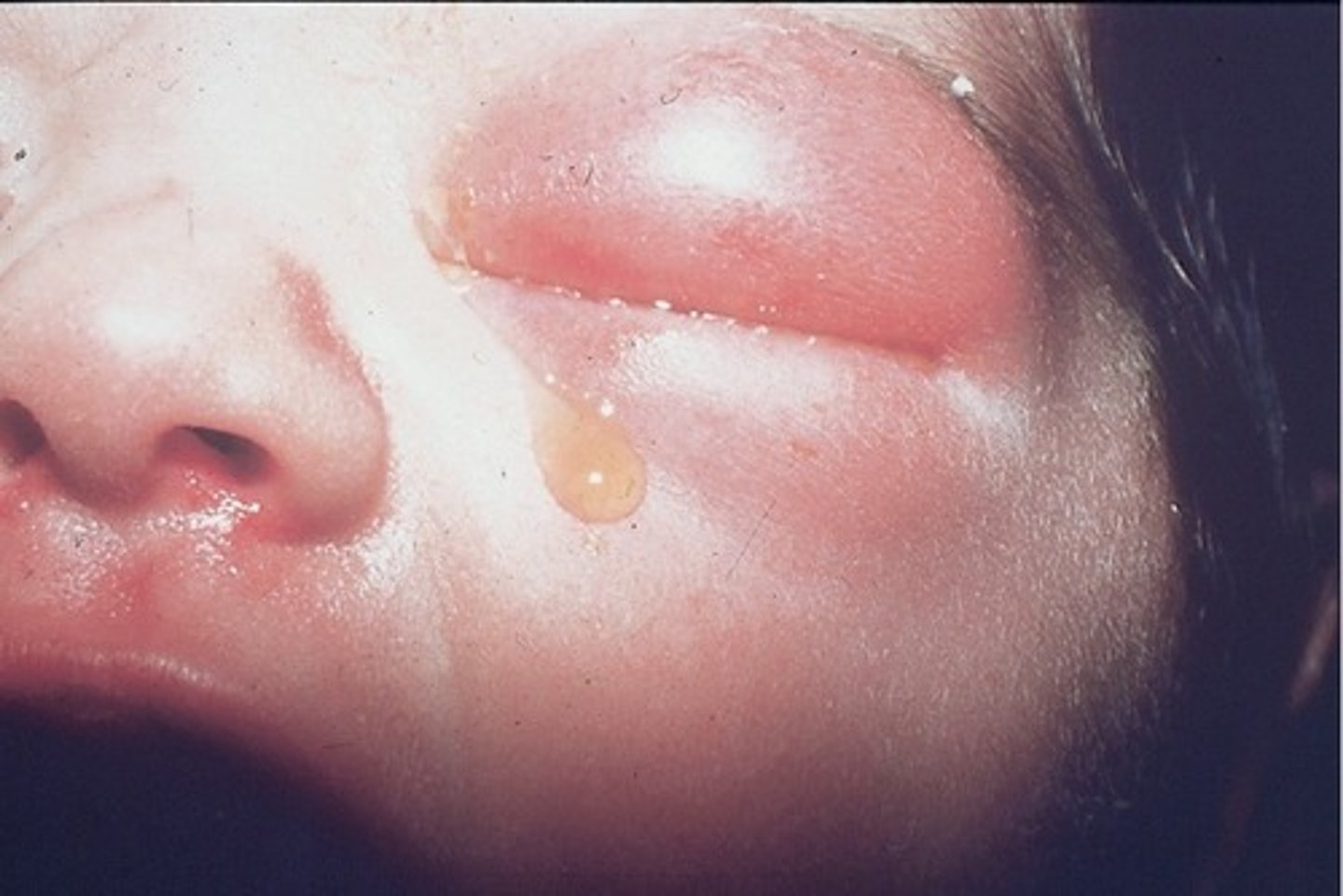 <p>conjunctivitis of the newborn</p>
