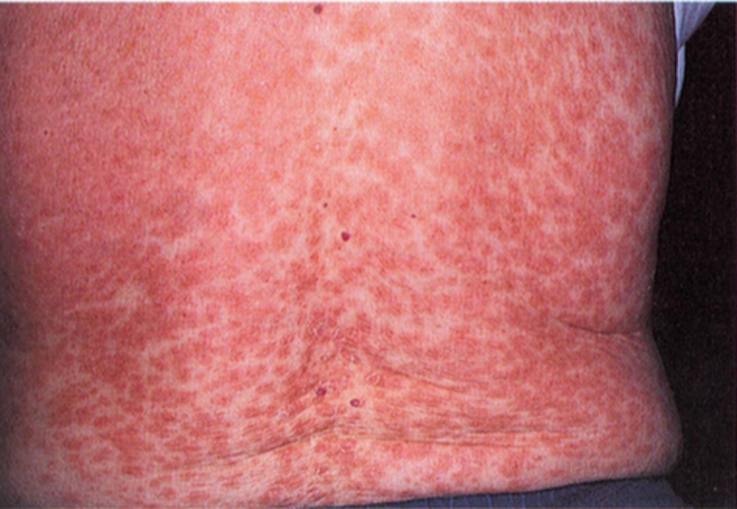 <p>95% of all drug eruptions</p>