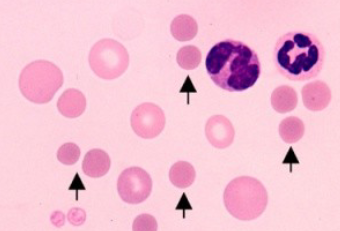 <ul><li><p>dark staining RBC’s with reduced or no central pallor</p></li><li><p>partial phagocytosis of cell</p><ul><li><p>response to antibodies</p></li></ul></li><li><p>suggest immune-mediated destruction of RBC</p></li><li><p>hard to detect in species other than canine </p></li></ul><p></p>