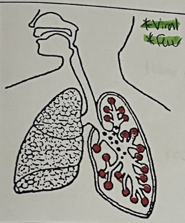 <p>Alveoli &amp; Blood Vessels</p>