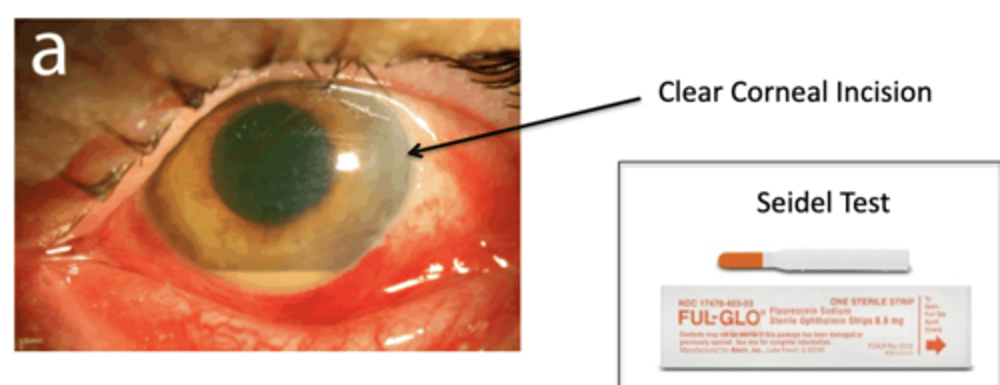 <p>What is the seidel test?</p>