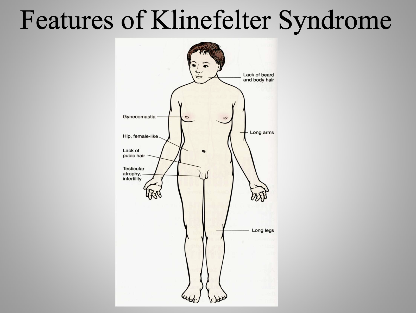 <p>Klinefelter Syndrome (XXY)</p>