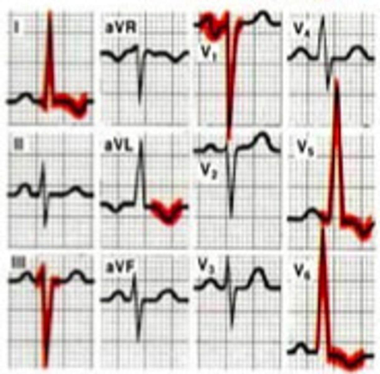 <p>V1 --&gt; deep/long S wave</p><p>V5/6 -&gt; tall/high R wave</p><p>count boxes together if &gt;35 LVH</p><p>causes: systemic HTN, aortic stenosis, mitral insuffic</p><p>(very common)</p>