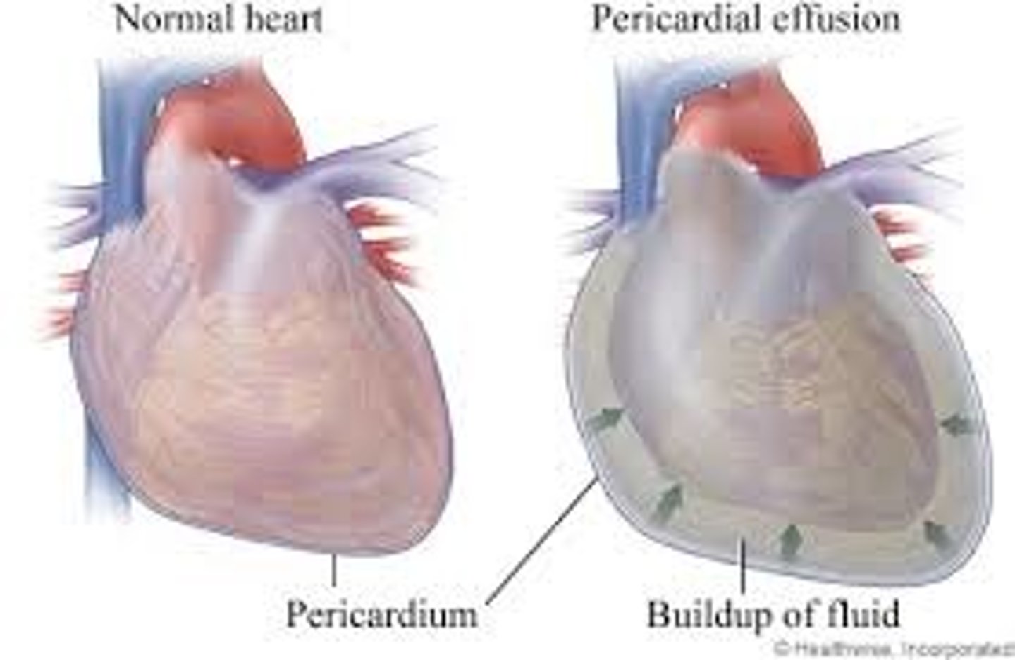 <p>Excess fluid in pericardial cavity causing pressure.</p>