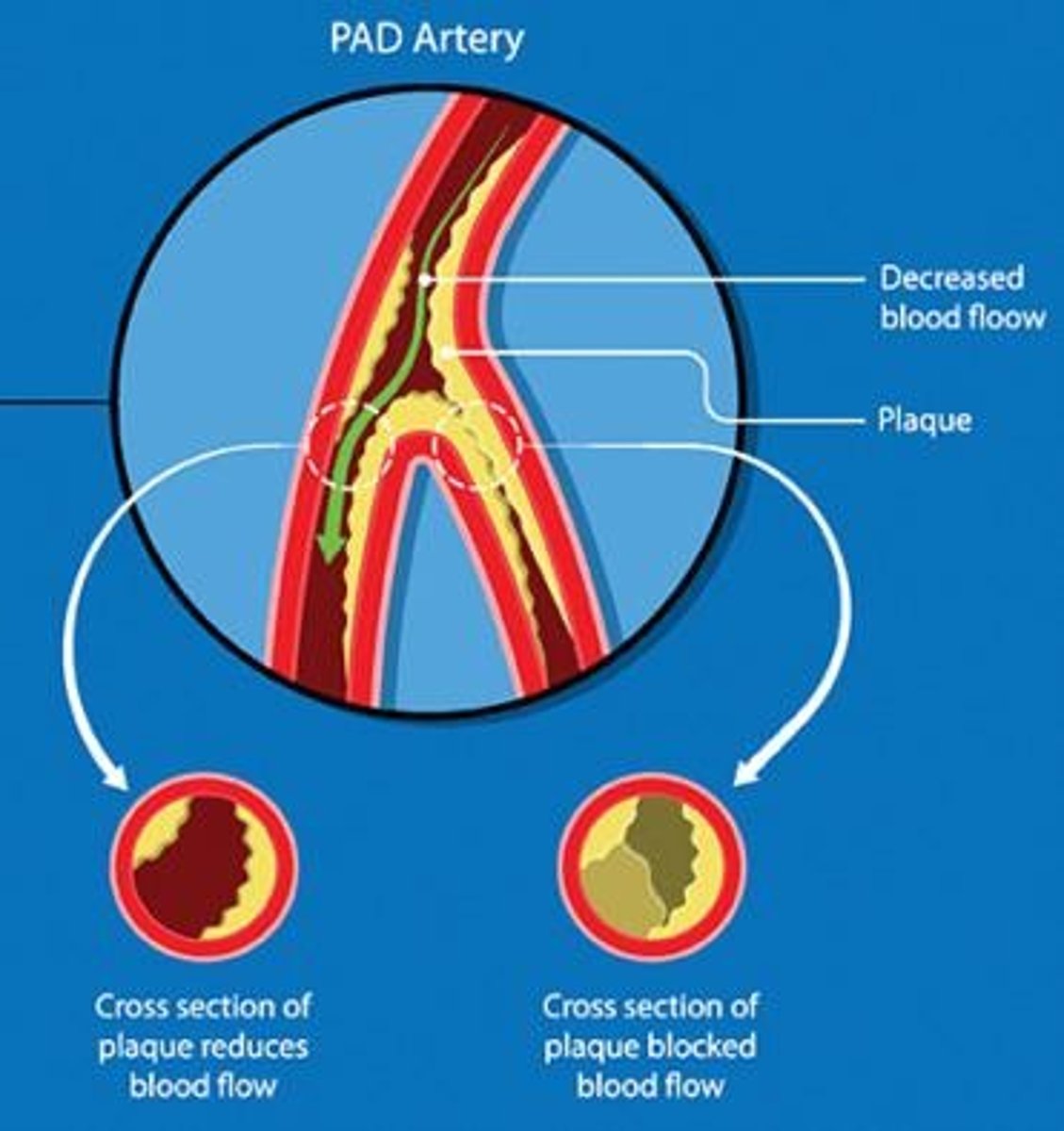 <p>Chronic disorder causing restricted blood flow in extremities.</p>