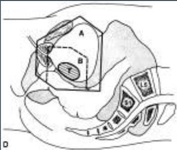 <p>4 field box with/without oblique combination</p><p>20 Gy / 10 fraction (so total treatment with phase 1 = 65 Gy / 35)</p><ul><li><p>8 Gy to entire bladder</p></li><li><p>12 Gy to tumor + 2 cm margin</p></li></ul><p></p>
