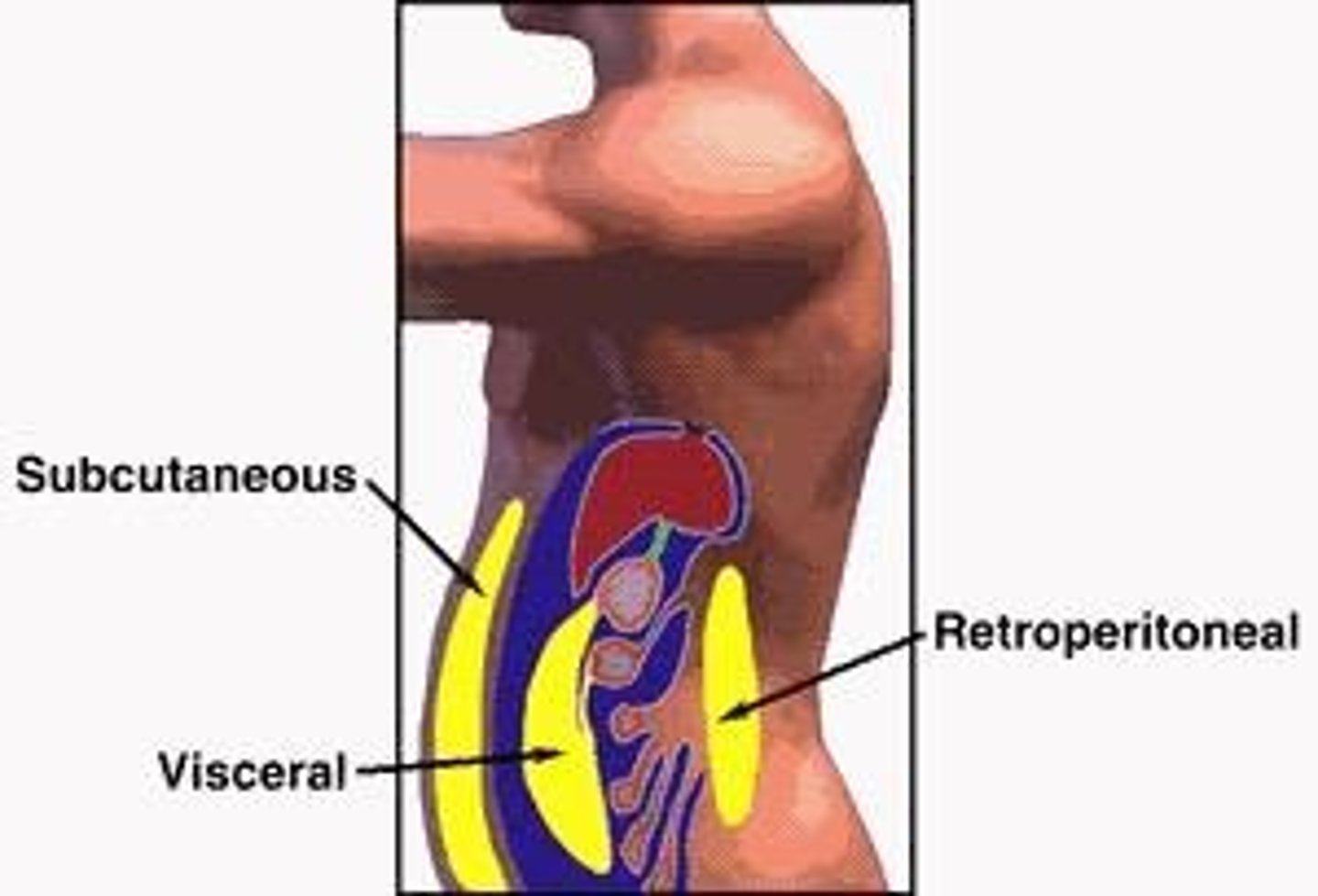 <p>Fat surrounding organs, increasing disease risk.</p>
