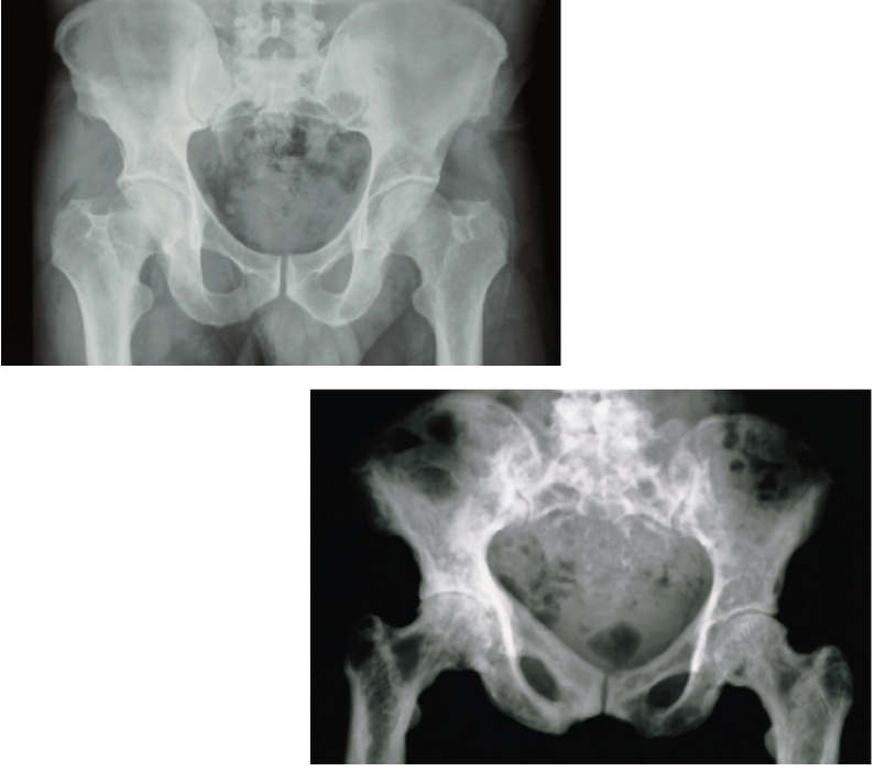 <ul><li><p><strong>Haphazard bone deposit and resorption</strong></p></li><li><p>Abnormally high ratio of <strong>spongy bone</strong></p></li><li><p>Commonly affects the: <strong>spine, pelvis, femur, skull</strong></p></li><li><p><strong>3% of elderly North Americans</strong> – rare before 40</p></li></ul><p></p>