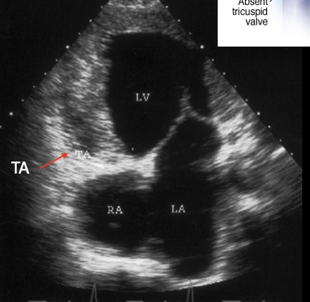 <p><span>is a condition present at birth (congenital heart disease), a solid wall of tissue blocks the blood flow between your right heart chambers.</span></p><p>This is?</p>