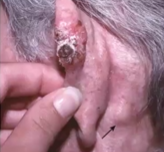 <ul><li><p>2nd most common type of skin cancer that typically occurs in sun exposed areas</p></li><li><p>Pathogenesis: most are mutated TP53 genes</p></li><li><p>Morphology: <strong>red scaling plaques</strong> that may ulcerate in ears hands lips and hands</p><ul><li><p>Entire <strong>epidermis is replaced by dysplastic keratinocyte</strong></p></li><li><p>Only metastasize after long periods of time</p></li></ul></li></ul><p></p>