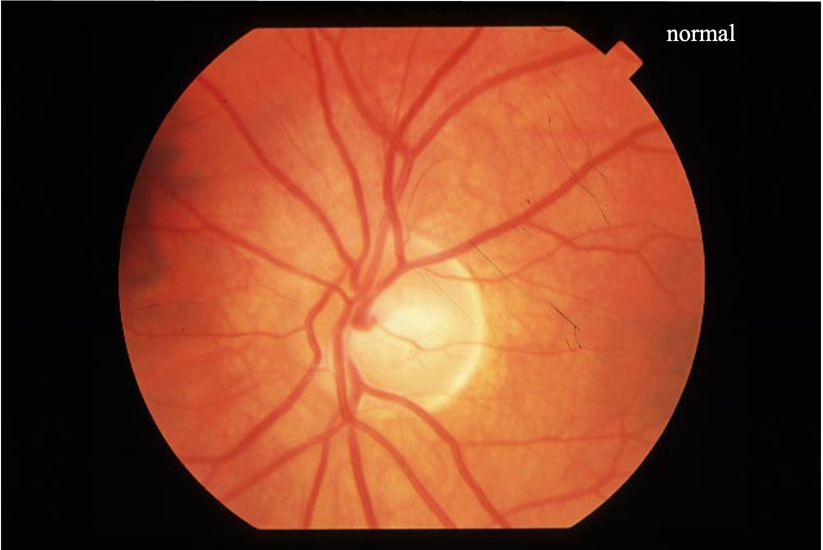<p>The absence of __________ is a characteristic of a normal optic disc.</p>
