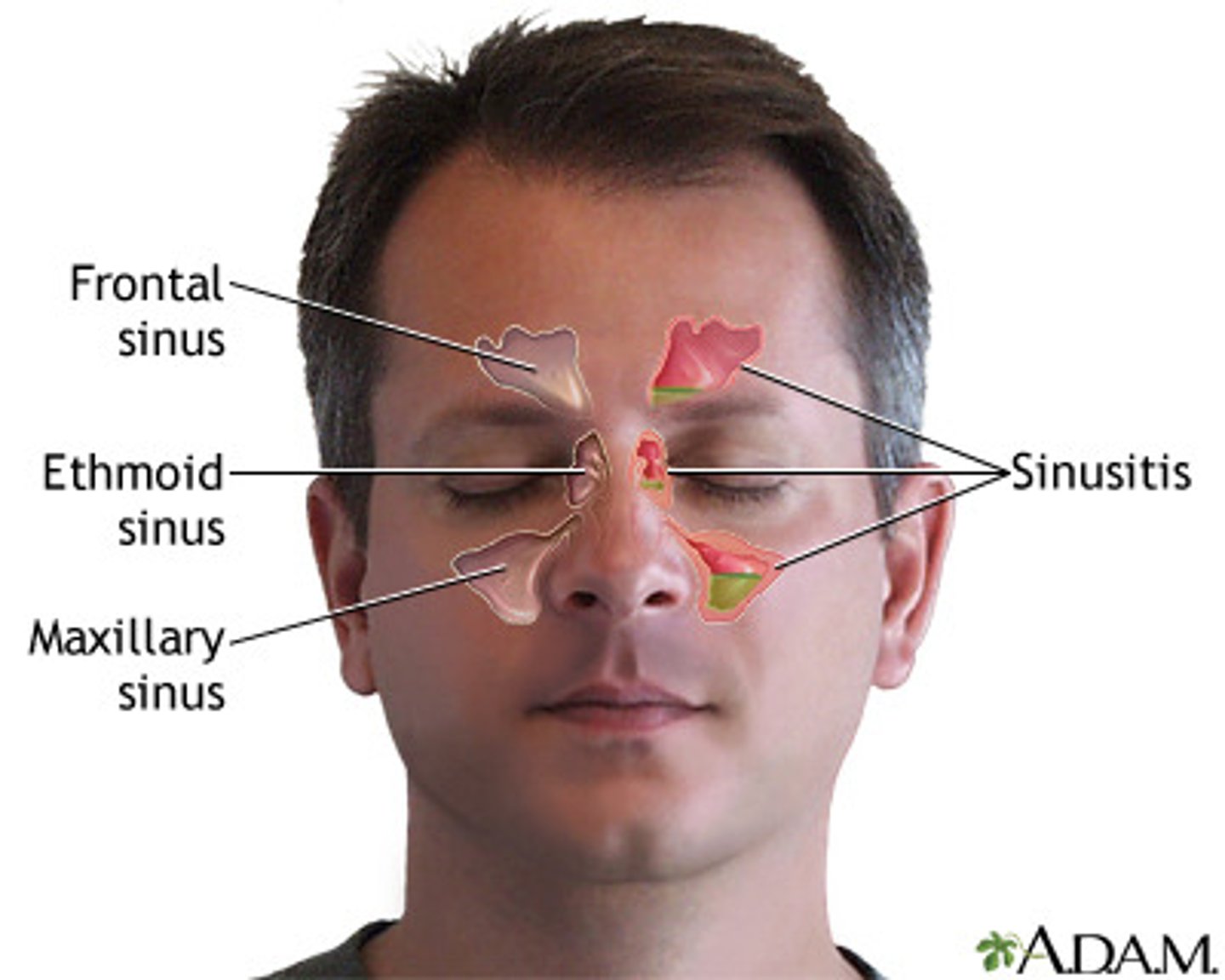 <p>inflammation of the sinuses</p>
