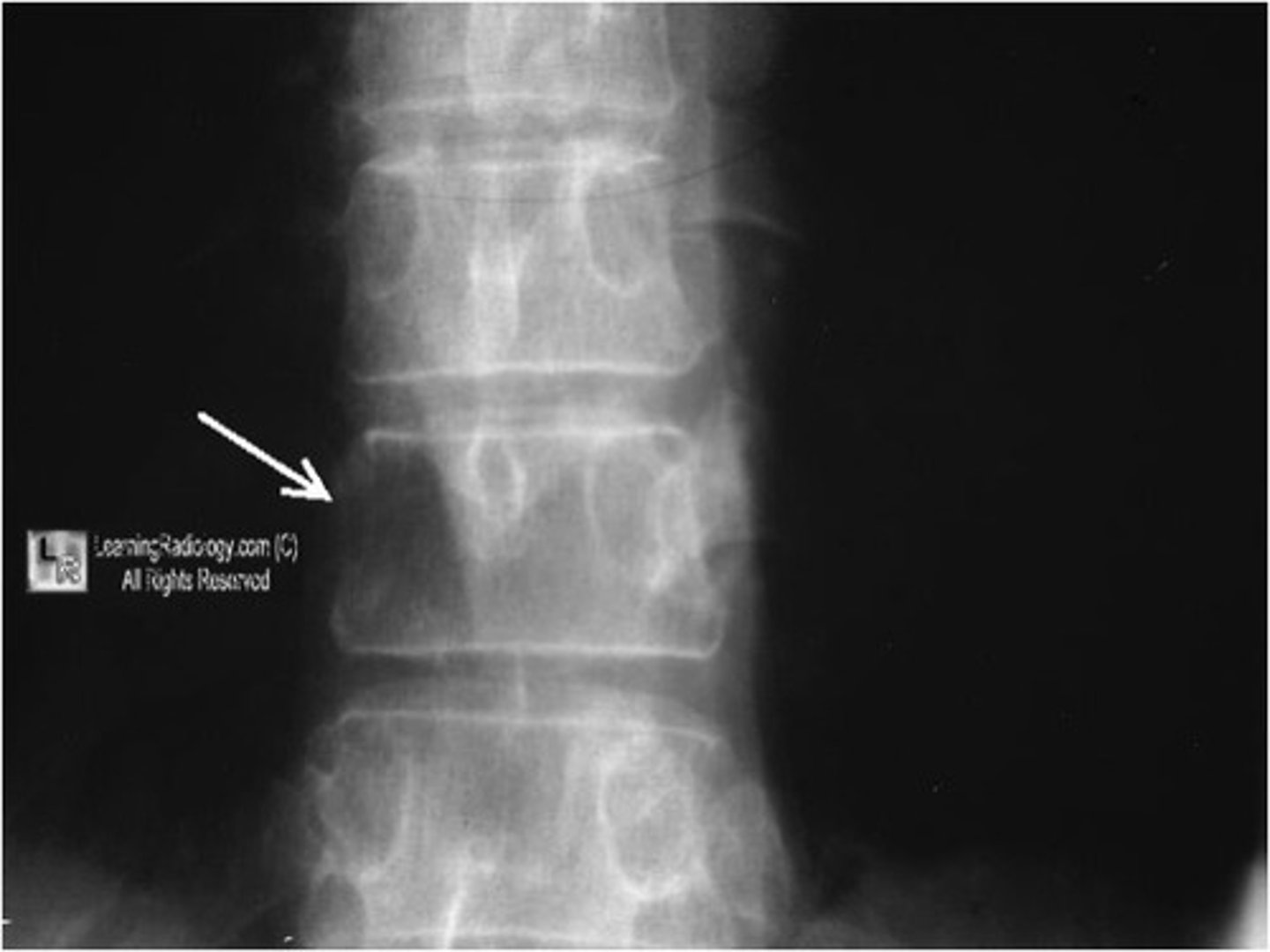 <p>osteolytic metastatic disease destroys pedicles because of their blood supply</p>