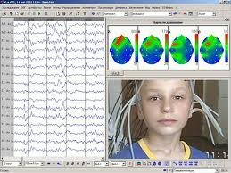 A recording of the waves of electrical activity that sweep across the brain's surface. These waves are measured by electrodes placed on the scalp. (EEG)