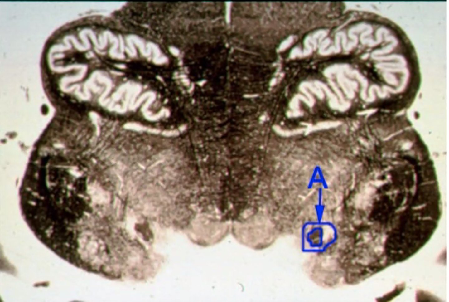 <p>Which 3 cranial nerves synapse here to relay taste & visceral sensations?<br><br>A. V, VII, X<br><br>B. V, VIII, IX<br><br>C. VI, IX, XII<br><br>D. VII, IX, X<br><br>E. VII, X, XII</p>