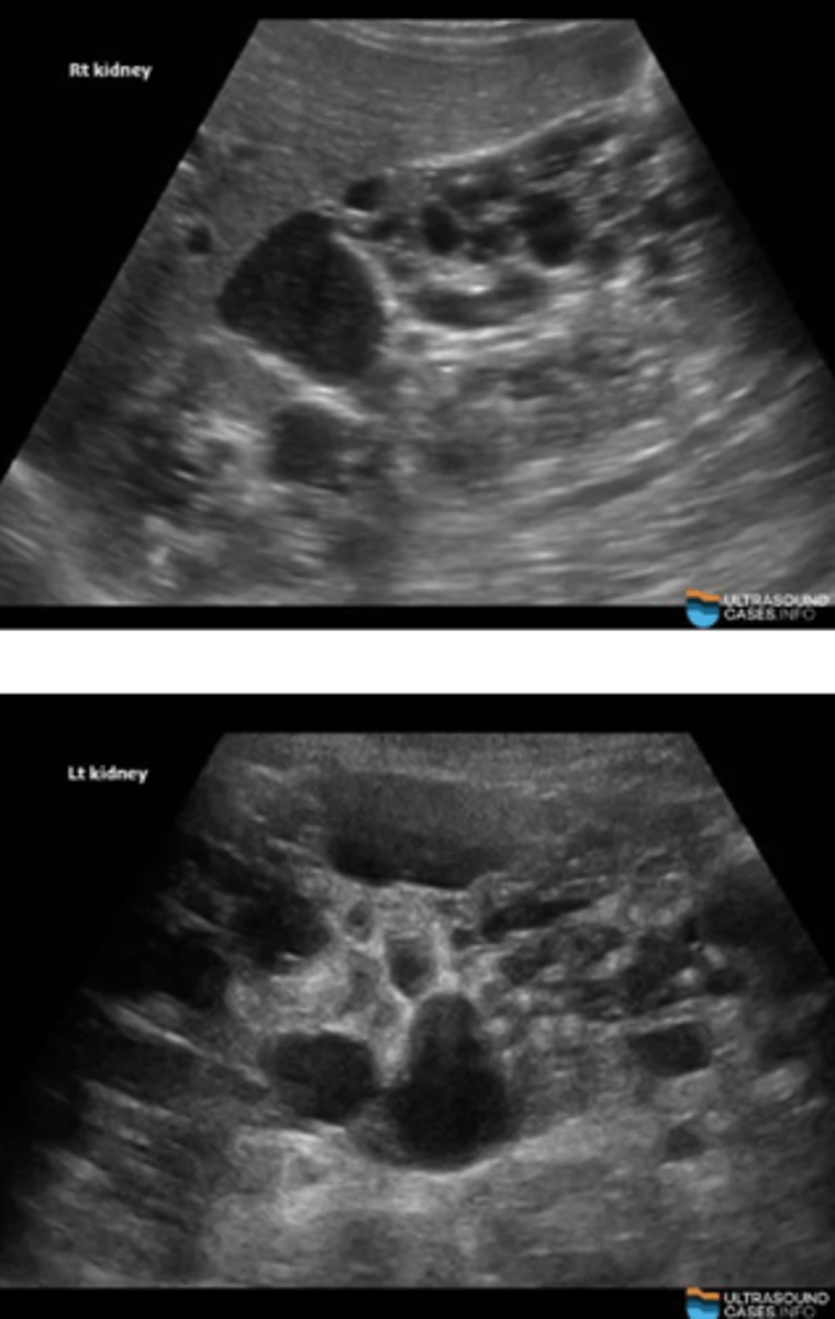 <p>d. Autosomal dominant polycystic kidneys</p>