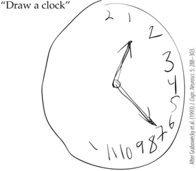 <p><span>A subject is instructed to draw a clock from memory. Her version is shown in the figure. What would the patient’s diagnosis most likely be?</span></p>