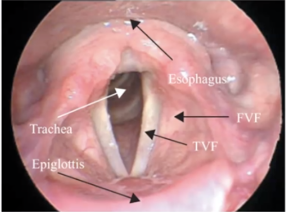 <ol><li><p>True Vocal Cords (TVF): Vocal cords that produce sound</p></li><li><p>False Vocal Cords (FVF): vestibular folds that help to close the larynx</p></li></ol>