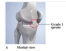 <p>- little fiber tearing/stretching<br><br>- stable valgus test<br><br>- normal ROM<br><br>- tx: POLICE (24 hrs), crutches, cryokinetics, 3 weeks recovery</p>