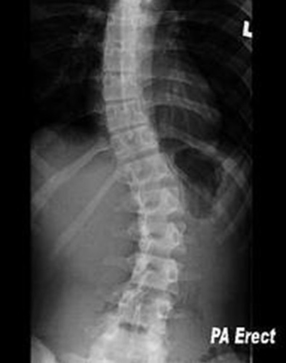 <p>- Patient supine, ASIS's equidistance from table</p><p>- Patient reaches lft/rt. for knees in bending images</p><p>- Collimate and center to MSP</p><p>- Obtain images from cervical to include crest</p>
