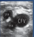<p>What is site 3 of a DVT?</p>