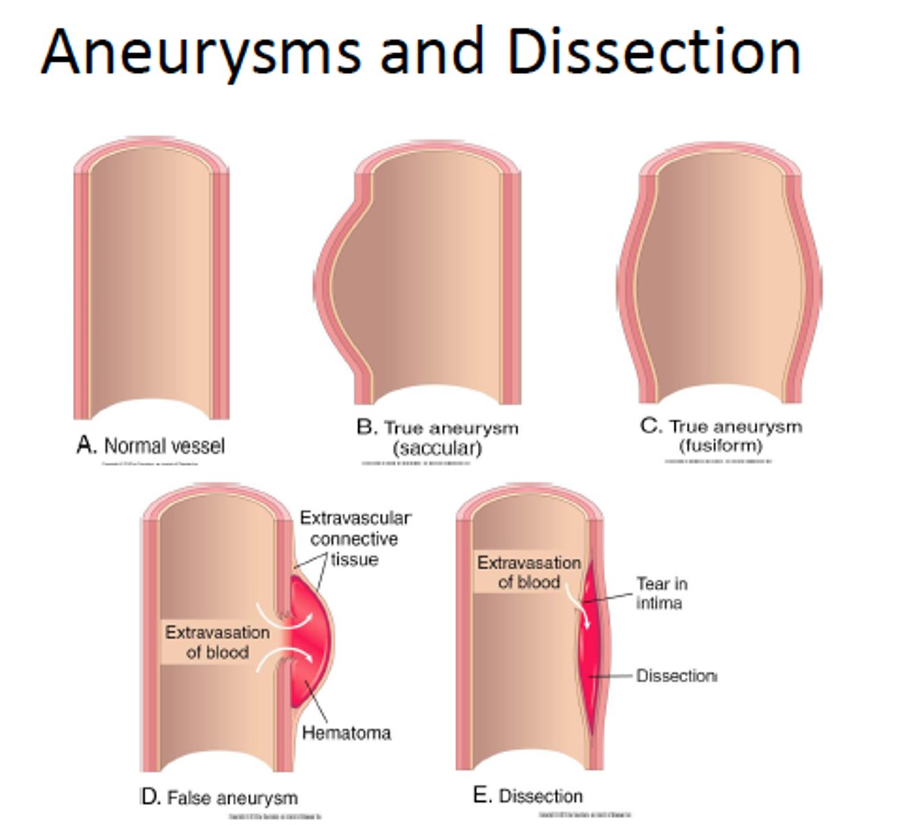 <p>- true aneurysm - involves all three layers of an artery (intimate, media and adventitia).</p><p>- false aneurysm - a locally contained hematoma. does not contain any layer of the vessel wall. a result of trauma the punctures the artery.</p>