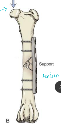 <ul><li><p><strong>Load sharing</strong></p><ul><li><p>Balance with degree of fixation and soft tissue damage</p></li><li><p><strong>Plate </strong>should absorbs <span style="color: red;">most the energy </span></p></li></ul></li><li><p><strong>Implant location</strong></p><ul><li><p><span style="color: red;">T<u>ension surface </u></span><u>**</u></p></li><li><p>Compression surface(weight is applied)</p></li></ul></li></ul><p><strong><u>GOAL</u></strong>: • Appropriate fracture healing • Restoration of function</p><p></p>