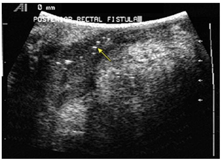 <p>45 y/o male presents to the ED for intermittent rectal pain that worsens on defecation and activity. On physical exam you note tenderness, erythema, and malodorous drainage. Imaging studies reveal <span>air in a fistula tract. What is the goal of surgery?</span></p>