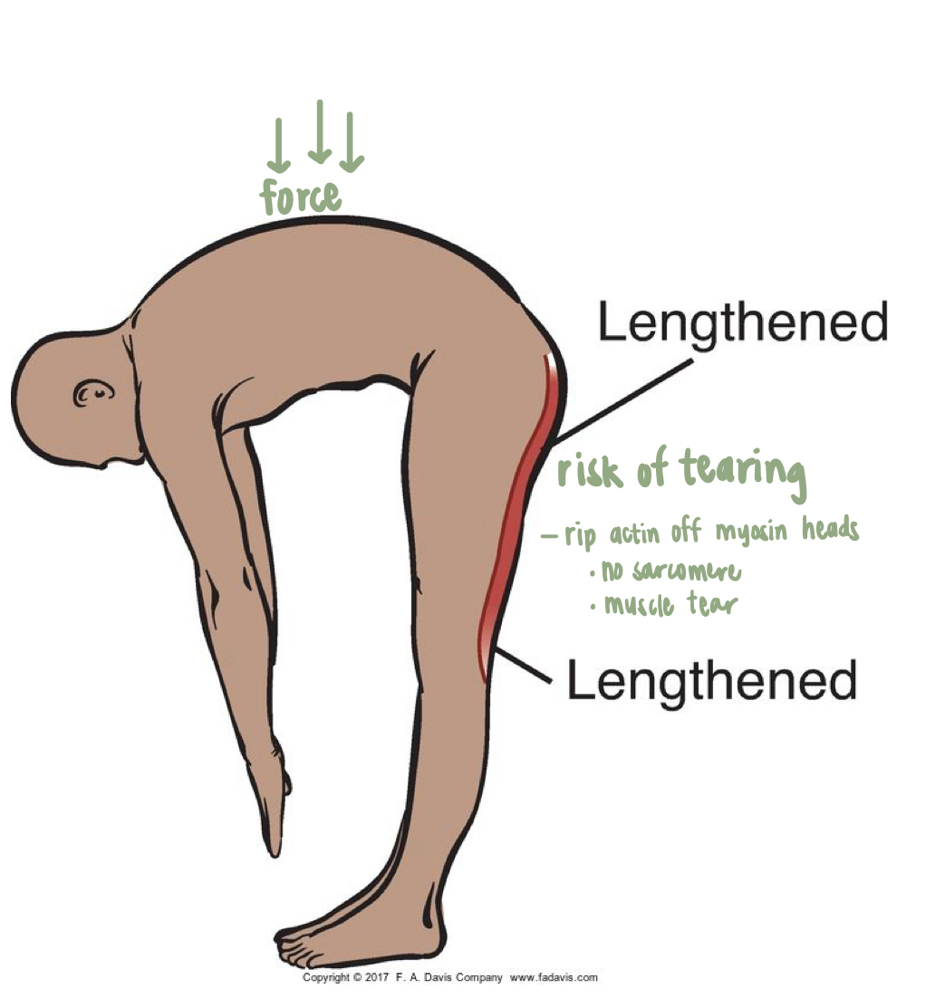 <ul><li><p>Both ends of muscle is lengthened</p></li><li><p>Add force = risk of tearing</p><ul><li><p>rip actin off myosin heads</p></li><li><p>no sarcomere</p></li><li><p>muscle tear</p></li></ul></li></ul><p></p>
