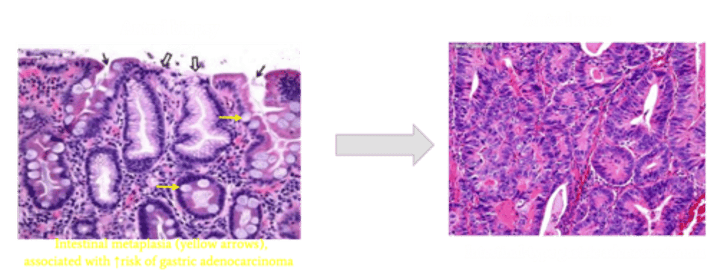 <p>Define Complication of Chronic Gastritis:</p><p>Precursor lesion to intestinal-type gastric adenocarcinoma</p><p>-Hx:</p><p>-Path: Chronic inflammation can also expose the gastric epithelium to constant regenerative change which can render it vulnerable to genetic alterations and then cancer</p>